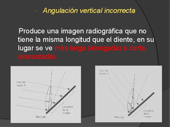  Angulación vertical incorrecta Produce una imagen radiográfica que no tiene la misma longitud