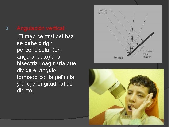 3. Angulación vertical: El rayo central del haz se debe dirigir perpendicular (en ángulo