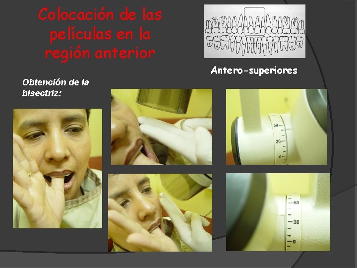 Colocación de las películas en la región anterior Obtención de la bisectriz: Antero-superiores 