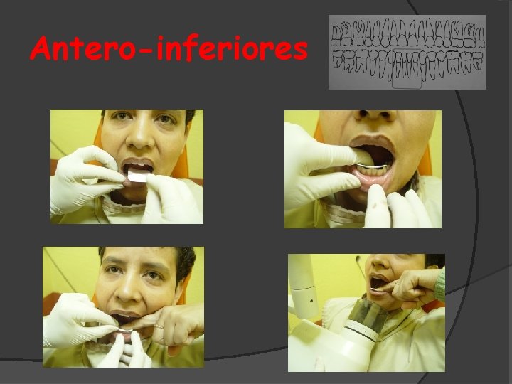 Antero-inferiores 