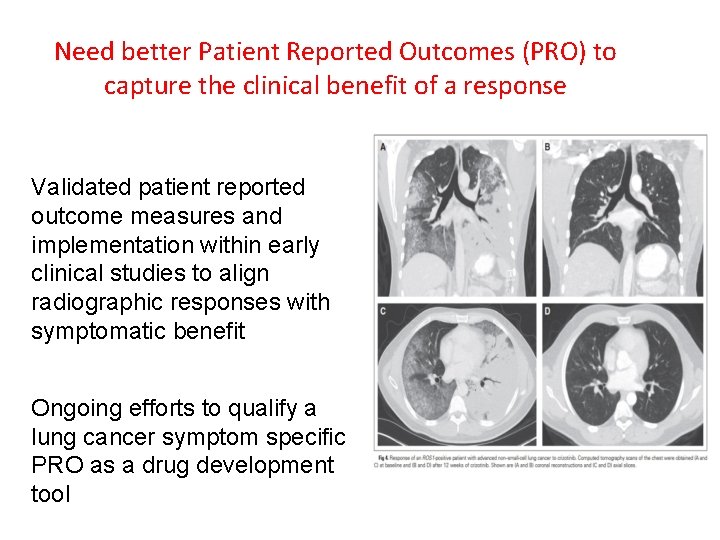 Need better Patient Reported Outcomes (PRO) to capture the clinical benefit of a response