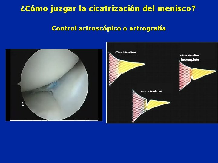 ¿Cómo juzgar la cicatrización del menisco? Control artroscópico o artrografía 