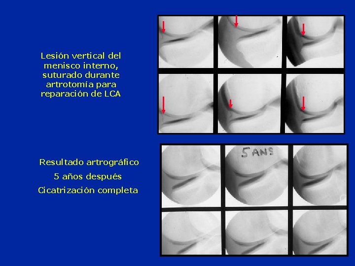 Lesión vertical del menisco interno, suturado durante artrotomía para reparación de LCA Resultado artrográfico