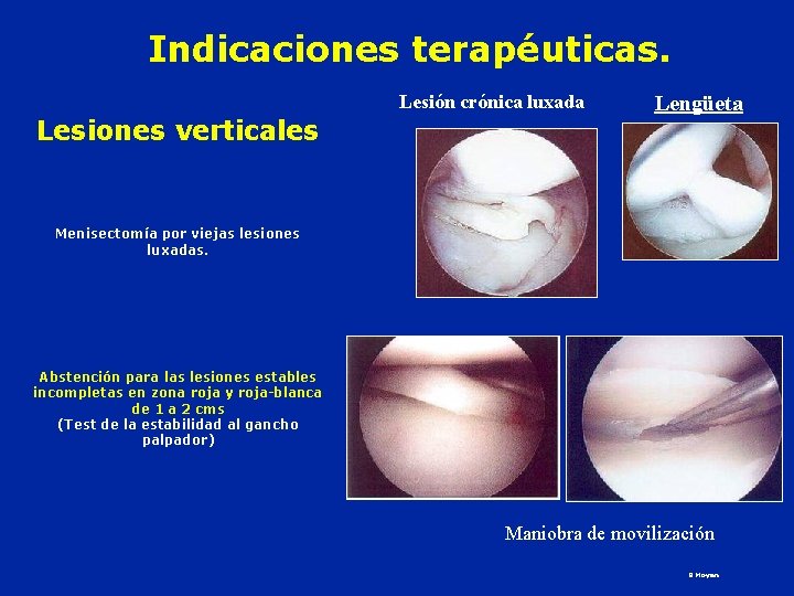 Indicaciones terapéuticas. Lesión crónica luxada Lesiones verticales Lengüeta Menisectomía por viejas lesiones luxadas. Abstención