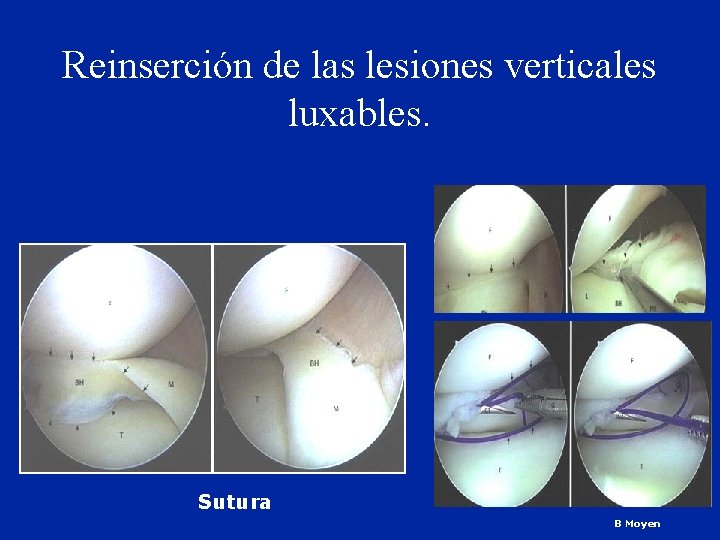 Reinserción de las lesiones verticales luxables. Sutura B Moyen 