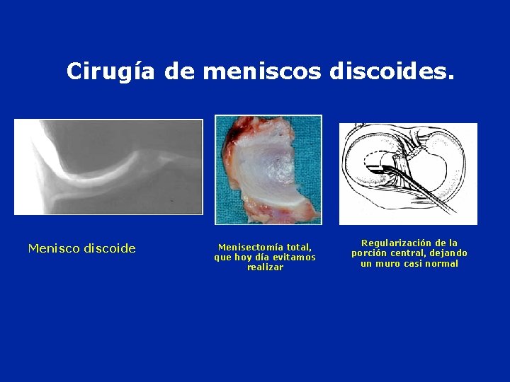  Cirugía de meniscos discoides. Menisco discoide Menisectomía total, que hoy día evitamos realizar