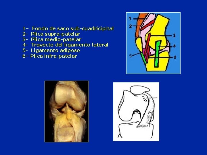  1– Fondo de saco sub-cuadricipital 2 - Plica supra-patelar 3 - Plica medio-patelar