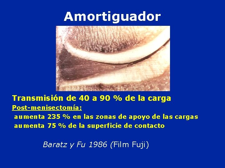 Amortiguador Transmisión de 40 a 90 % de la carga Post-menisectomía: aumenta 235 %