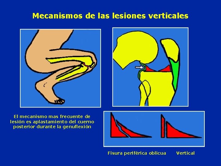 Mecanismos de las lesiones verticales El mecanismo mas frecuente de lesión es aplastamiento del