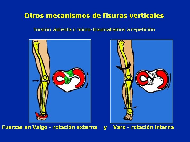 Otros mecanismos de fisuras verticales Torsión violenta o micro-traumatismos a repetición Fuerzas en Valgo