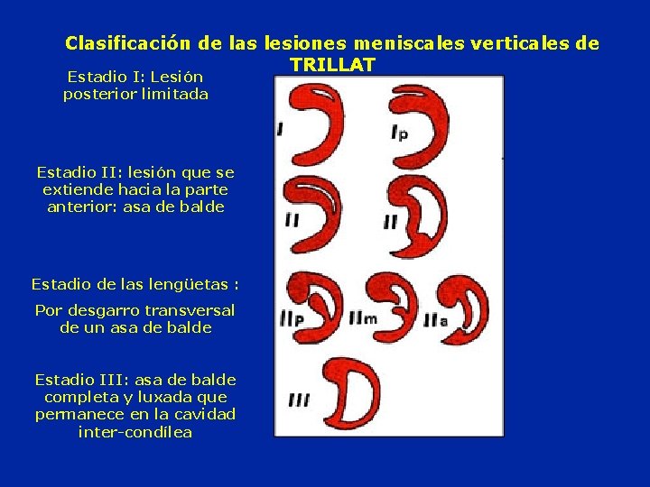 Clasificación de las lesiones meniscales verticales de TRILLAT Estadio I: Lesión posterior limitada Estadio