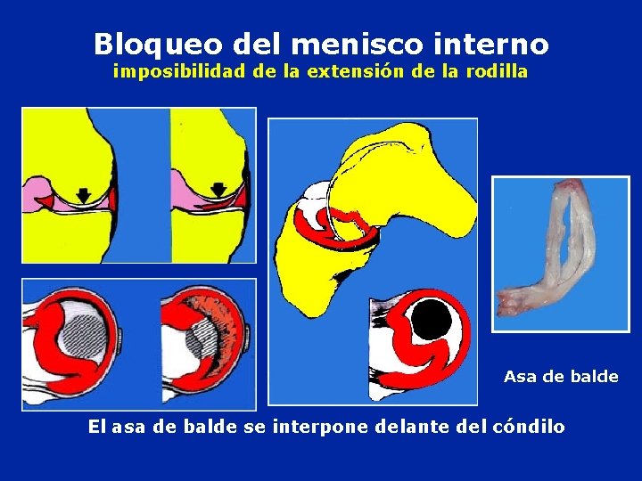 Bloqueo del menisco interno imposibilidad de la extensión de la rodilla Asa de balde