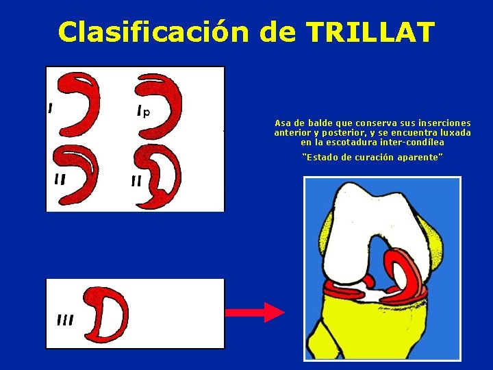 Clasificación de TRILLAT Asa de balde que conserva sus inserciones anterior y posterior, y