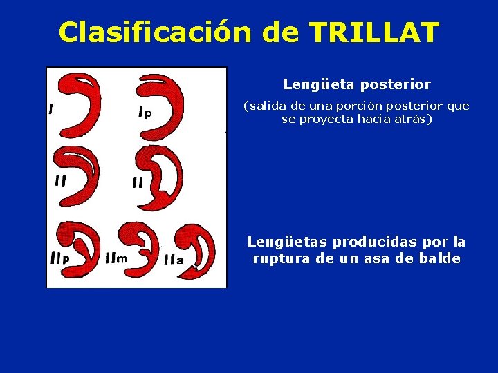Clasificación de TRILLAT Lengüeta posterior (salida de una porción posterior que se proyecta hacia