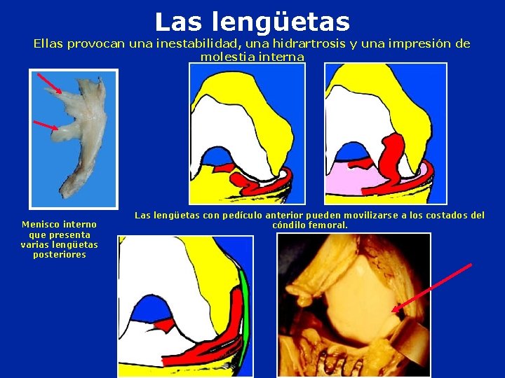 Las lengüetas Ellas provocan una inestabilidad, una hidrartrosis y una impresión de molestia interna