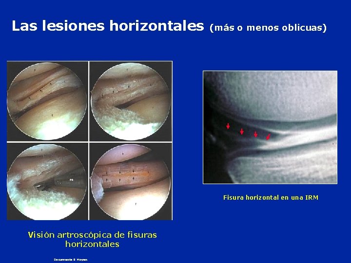 Las lesiones horizontales (más o menos oblicuas) Fisura horizontal en una IRM Visión artroscópica
