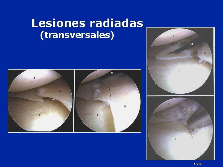 Lesiones radiadas (transversales) B Moyen 