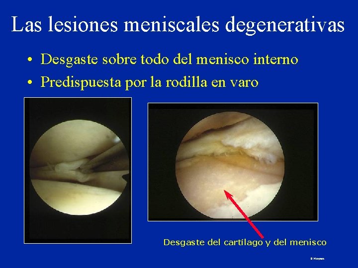 Las lesiones meniscales degenerativas • Desgaste sobre todo del menisco interno • Predispuesta por