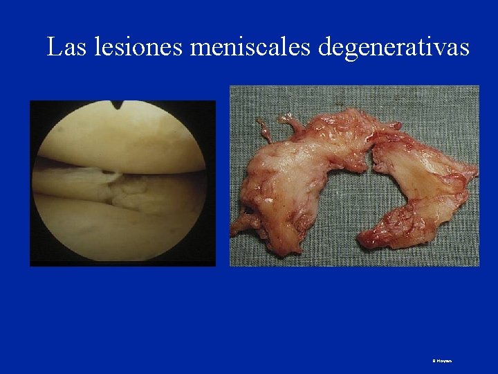 Las lesiones meniscales degenerativas B Moyen 