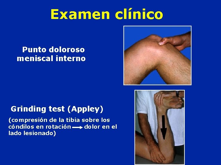 Examen clínico Punto doloroso meniscal interno Grinding test (Appley) (compresión de la tibia sobre