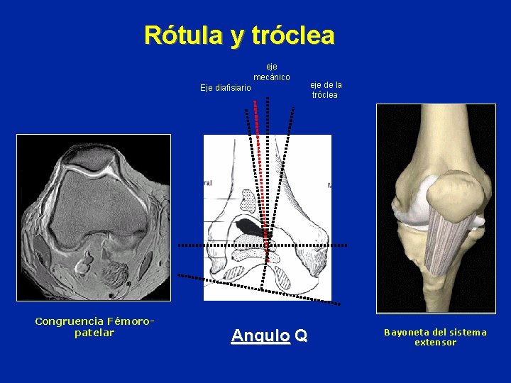 Rótula y tróclea eje mecánico Eje diafisiario Congruencia Fémoropatelar Angulo Q eje de la