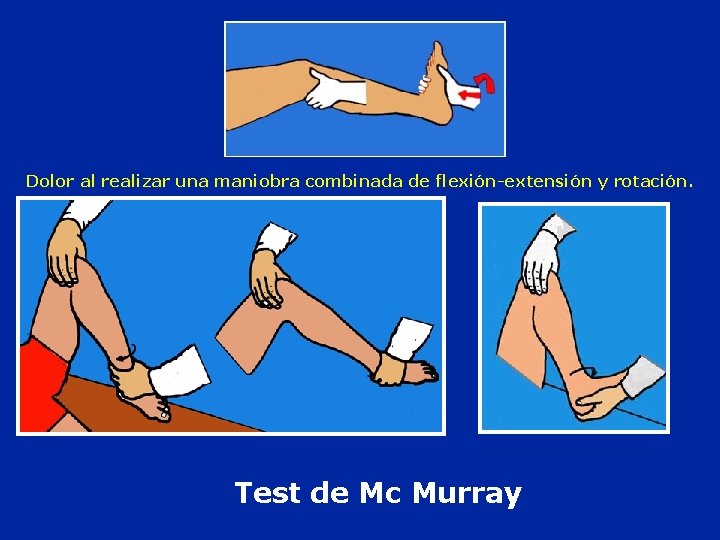 Dolor al realizar una maniobra combinada de flexión-extensión y rotación. Test de Mc Murray