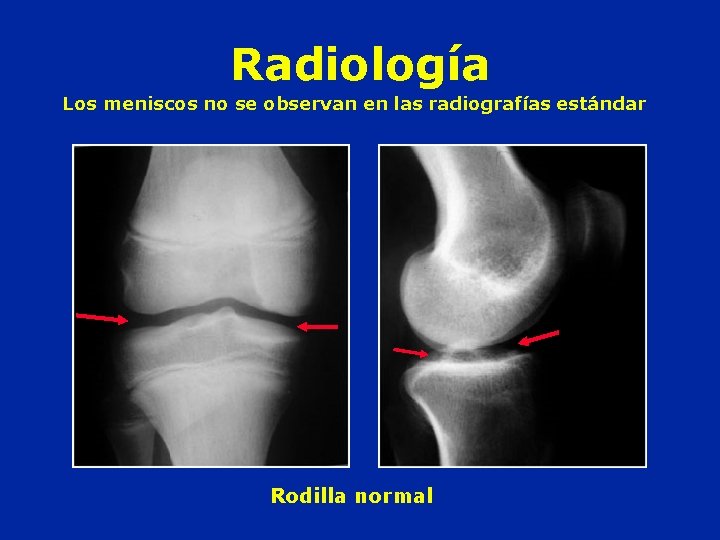 Radiología Los meniscos no se observan en las radiografías estándar Rodilla normal 