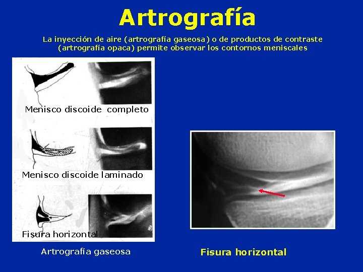 Artrografía La inyección de aire (artrografía gaseosa) o de productos de contraste (artrografía opaca)