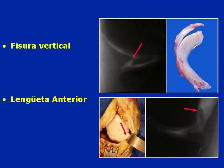  • Fisura vertical • Lengüeta Anterior 