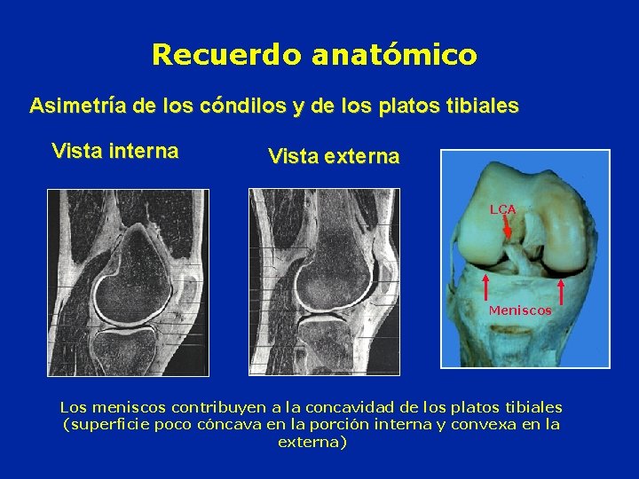 Recuerdo anatómico Asimetría de los cóndilos y de los platos tibiales Vista interna Vista