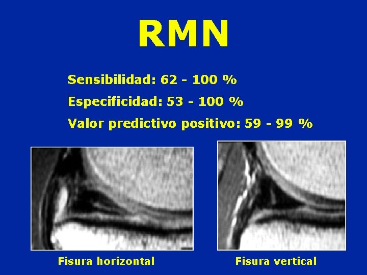 RMN Sensibilidad: 62 - 100 % Especificidad: 53 - 100 % Valor predictivo positivo: