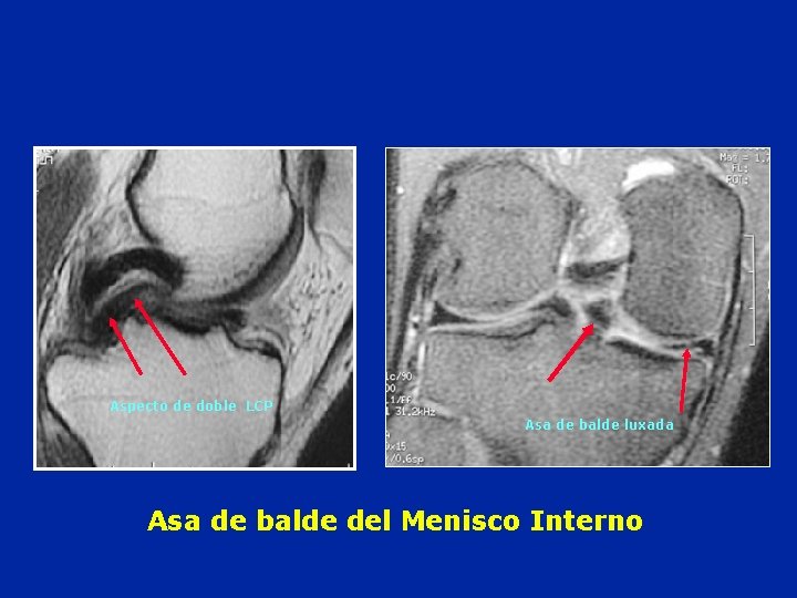 Aspecto de doble LCP Asa de balde luxada Asa de balde del Menisco Interno