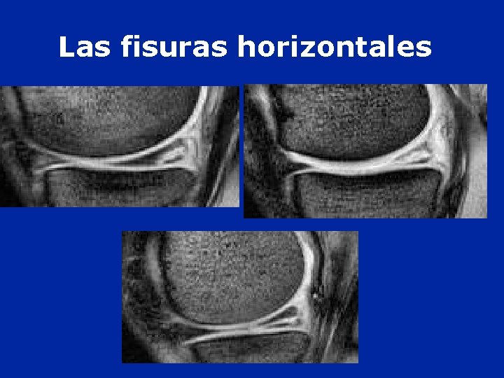 Las fisuras horizontales 