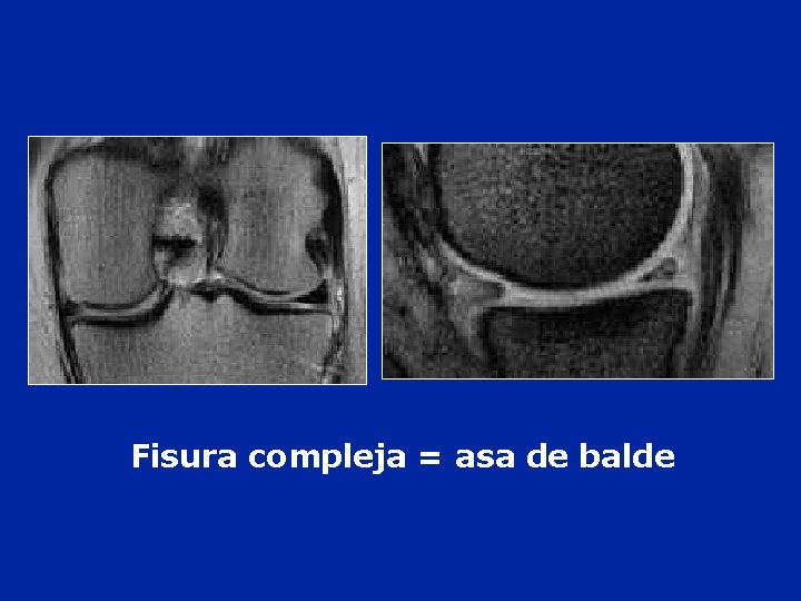 Fisura compleja = asa de balde 