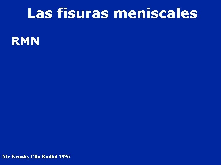 Las fisuras meniscales RMN Mc Kenzie, Clin Radiol 1996. 