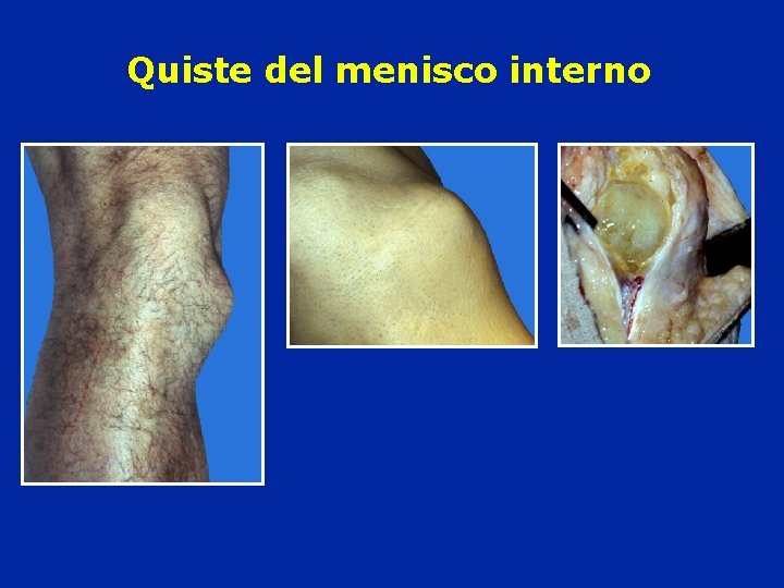 Quiste del menisco interno 