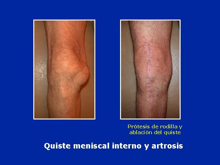 Prótesis de rodilla y ablación del quiste Quiste meniscal interno y artrosis 