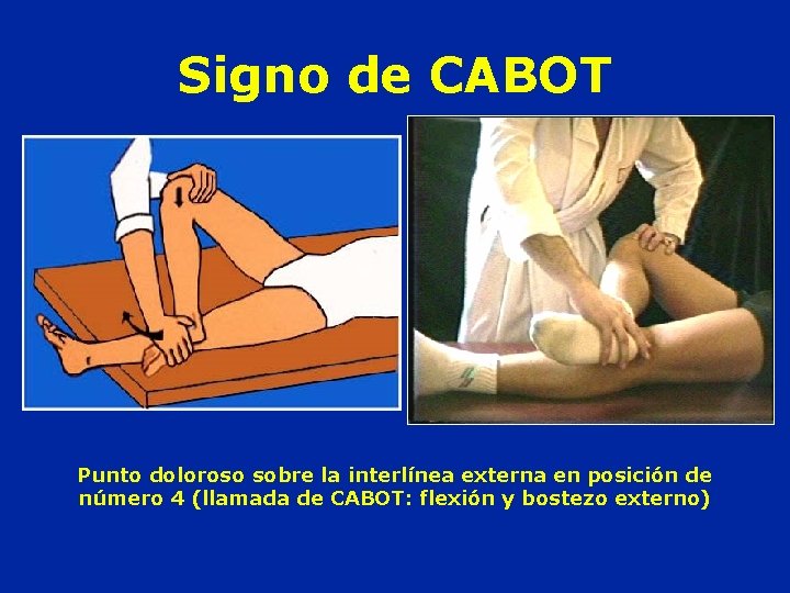 Signo de CABOT Punto doloroso sobre la interlínea externa en posición de número 4