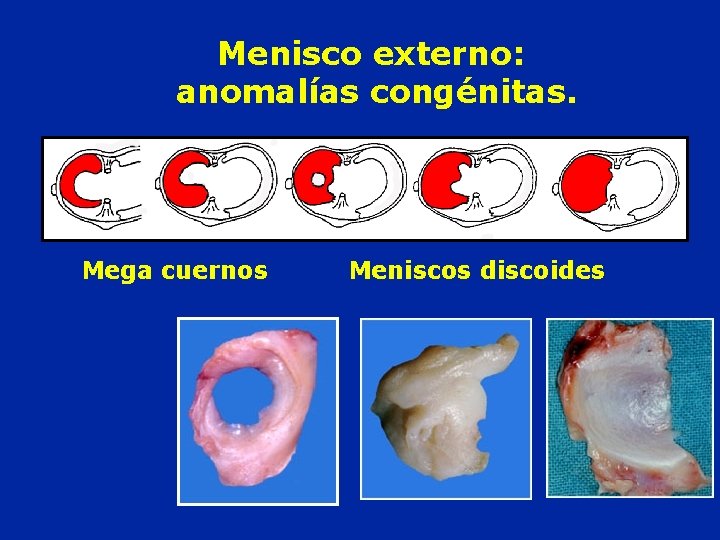 Menisco externo: anomalías congénitas. Mega cuernos Meniscos discoides 