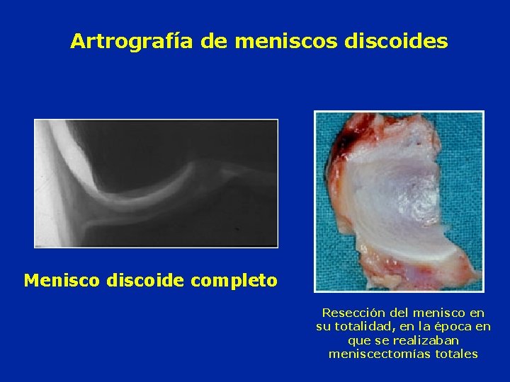 Artrografía de meniscos discoides Menisco discoide completo Resección del menisco en su totalidad, en