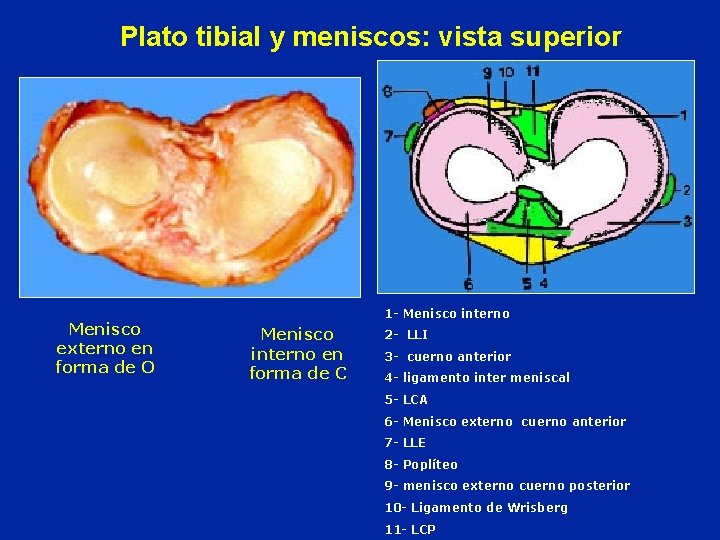 Plato tibial y meniscos: vista superior Menisco externo en forma de O 1 -