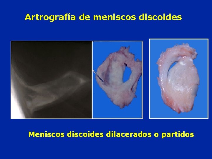 Artrografía de meniscos discoides Meniscos discoides dilacerados o partidos 