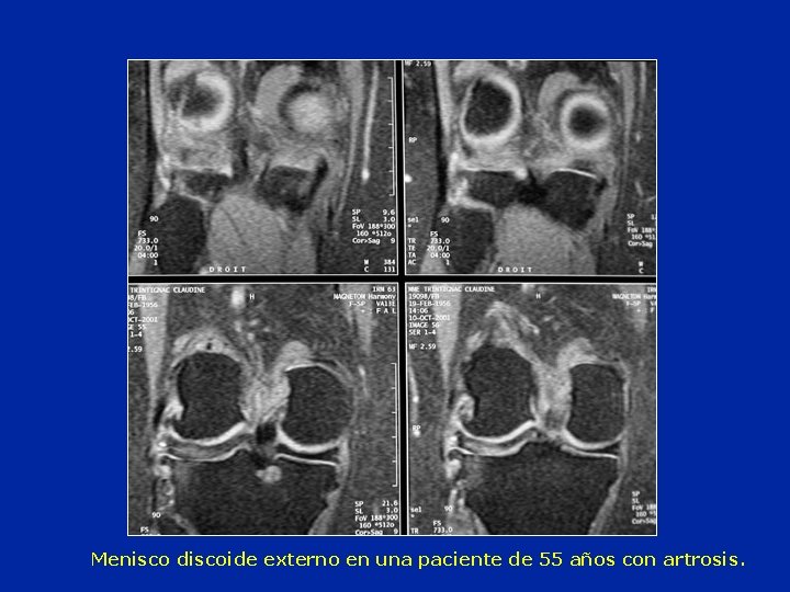 Menisco discoide externo en una paciente de 55 años con artrosis. 