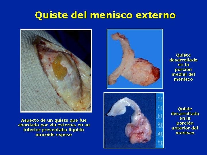 Quiste del menisco externo Quiste desarrollado en la porción medial del menisco Aspecto de