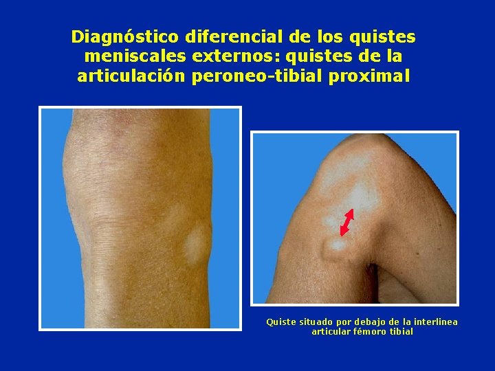 Diagnóstico diferencial de los quistes meniscales externos: quistes de la articulación peroneo-tibial proximal Quiste