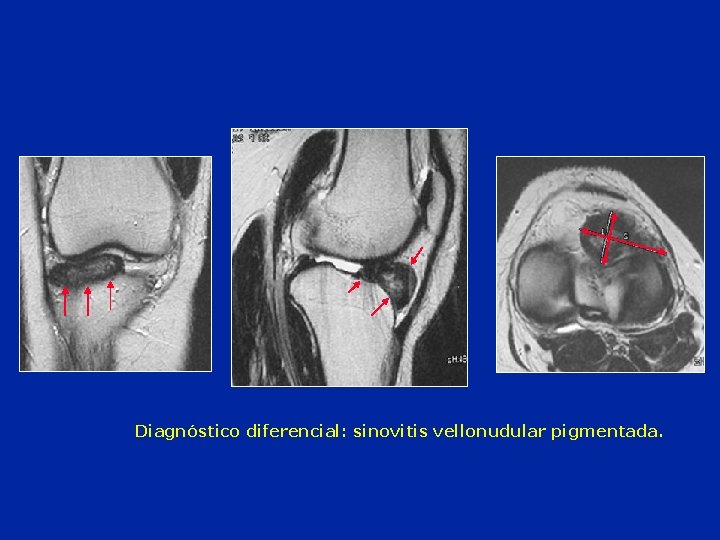 Diagnóstico diferencial: sinovitis vellonudular pigmentada. 