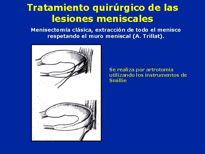 Tratamiento quirúrgico de las lesiones meniscales Menisectomía clásica, extracción de todo el menisco respetando