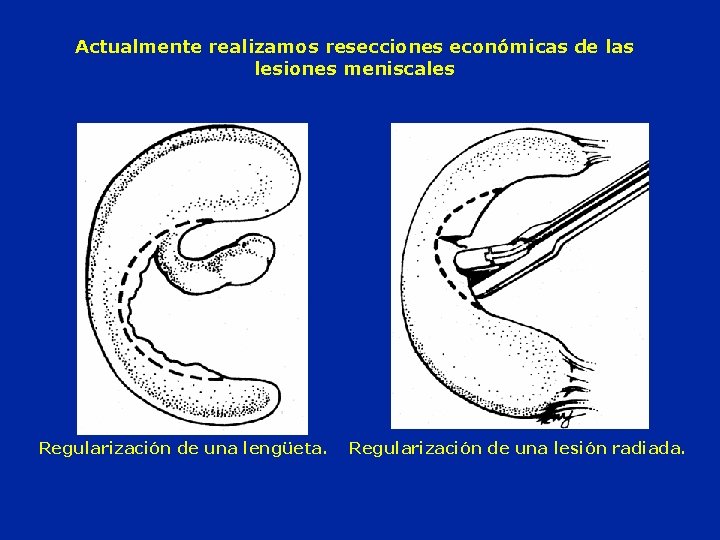 Actualmente realizamos resecciones económicas de las lesiones meniscales Regularización de una lengüeta. Regularización de