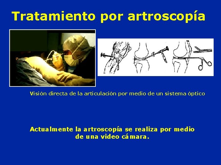 Tratamiento por artroscopía Visión directa de la articulación por medio de un sistema óptico