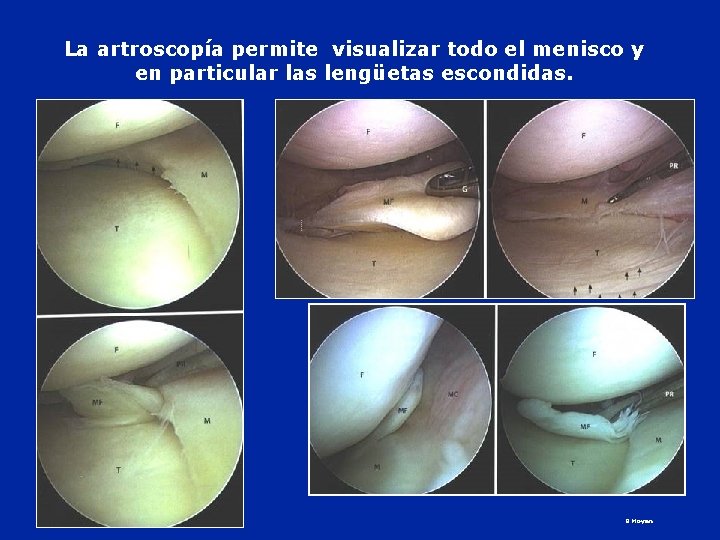 La artroscopía permite visualizar todo el menisco y en particular las lengüetas escondidas. B